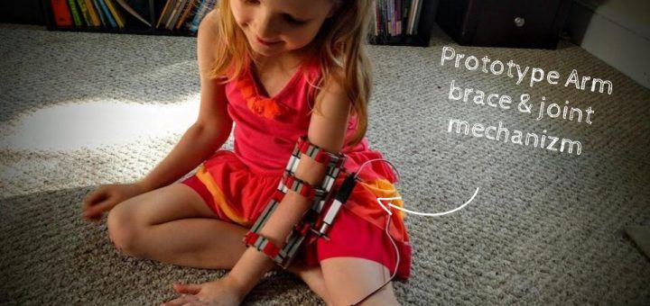 protesis1 720x340 - Construye una prótesis de rehabilitación con Impresión 3D y Arduino