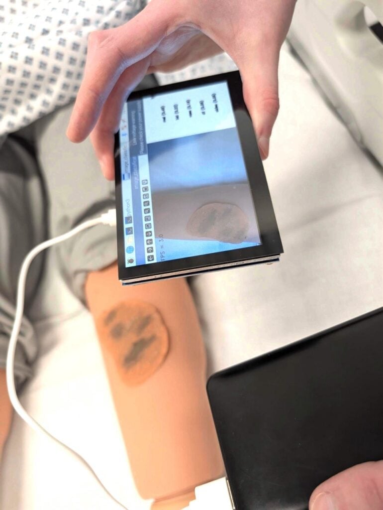 Interfaz de LesionIQ analizando una fotografía de una lesión cutánea con Raspberry Pi